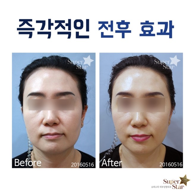 [구로리프팅]통증없는 즉각 효과! 슈퍼스타 에어젯 골드 리프팅으로 동안 외모 만들기! 관련 이미지 8
