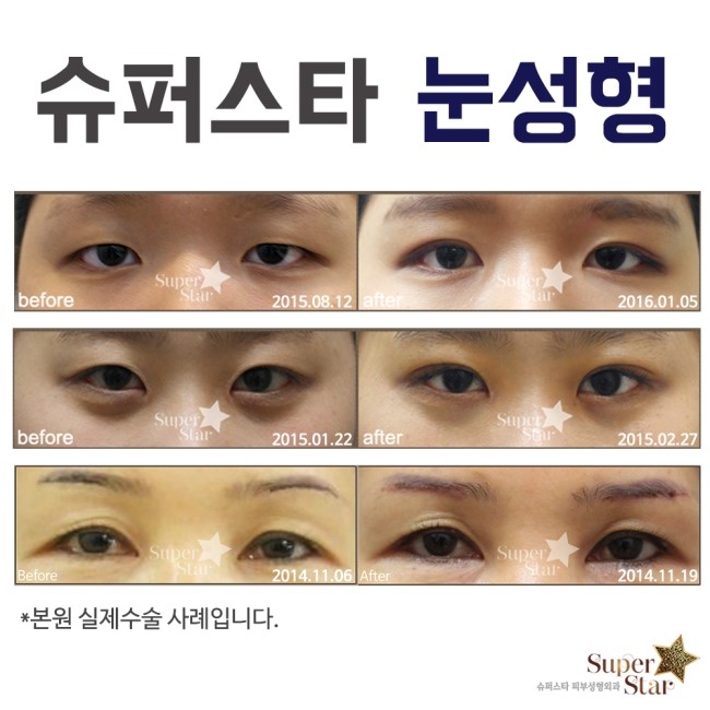 [대림성형외과]대림역에서 가까운 성형외과 슈퍼스타! 슈퍼스타에서 건강한 아름다움을 찾으세요★ 관련 이미지 4