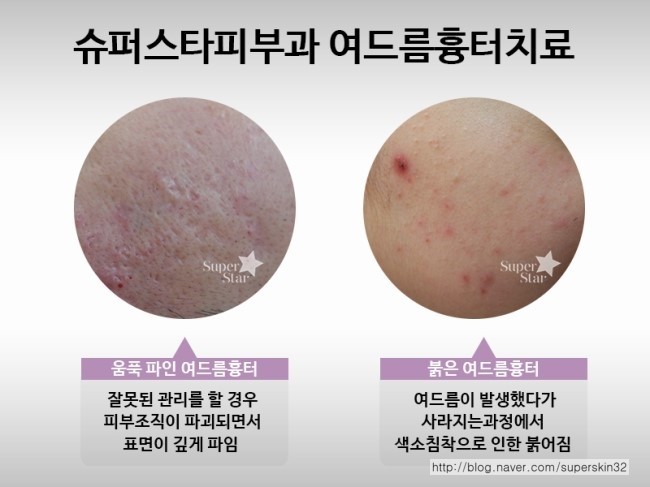 [구로피부과]구로여드름 슈퍼스타피부과 여드름흉터치료 ~ 말끔한 효과 다들 보러가요!! 관련 이미지 2