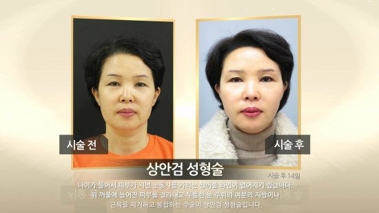 [구로눈성형]연말부모님께 선물하세요~슈퍼스타피부성형외과 상안검성형술눈썹거상술!!눈썹거상술 솔직한 인터뷰~ 관련 이미지 6