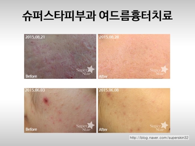 [구로피부과]구로여드름 슈퍼스타피부과 여드름흉터치료 ~ 말끔한 효과 다들 보러가요!! 관련 이미지 4