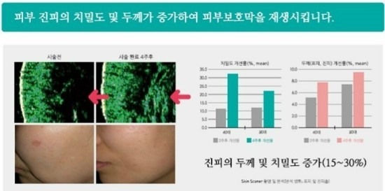 리쥬란 힐러로 젊고 건강한 피부를 회복하세요~ 관련 이미지 5