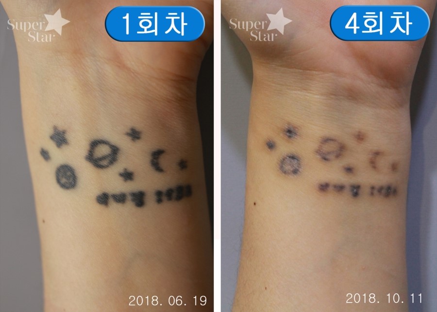 구로디지털단지피부과 피코플러스 문신제거 관련 이미지 5