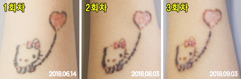 영등포/신도림피부과 문신제거는 피코플러스네요 관련 이미지 3