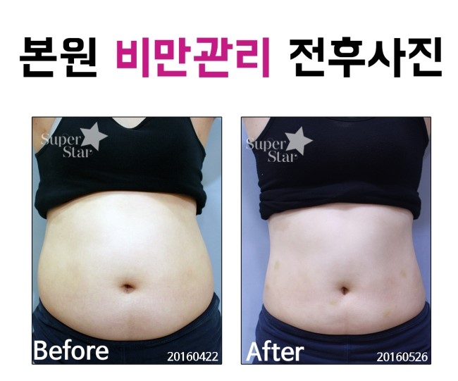 [구로피부과전문의]슈퍼스타피부과의 카복시 한달 무제한 EVENT! 피부과전문의 병원에서 안전하게 시술받으세요~ 관련 이미지 2