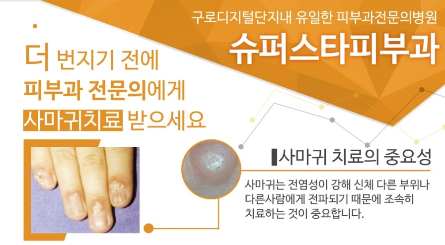 [구로피부과전문의]구로 사마귀치료!구로디지털단지내 유일한 피부과 전문의 병원 슈퍼스타피부과에서 치료하세요~ 관련 이미지 1