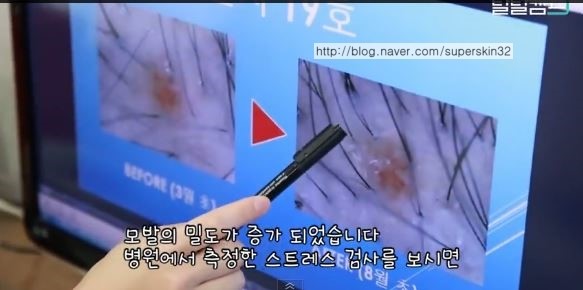 [구로탈모]구로피부과 슈퍼스타피부과 피부과전문의와 함께하는 탈탈캠프 19호님~ 6개월간의 기록입니다. 관련 이미지 9