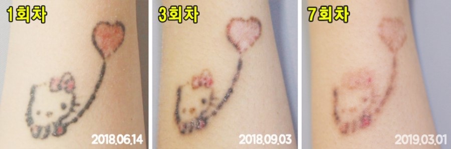 구로디지털단지역피부과 문신제거 정보드려요 관련 이미지 5