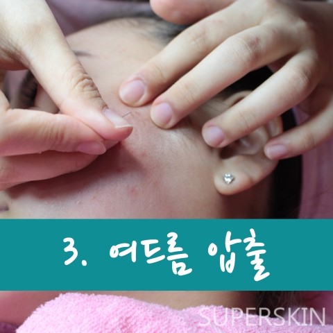 [구로피부과]여드름 근본부터 치료하자, 여드름 치료 이노플러스 공개합니다~ 관련 이미지 5