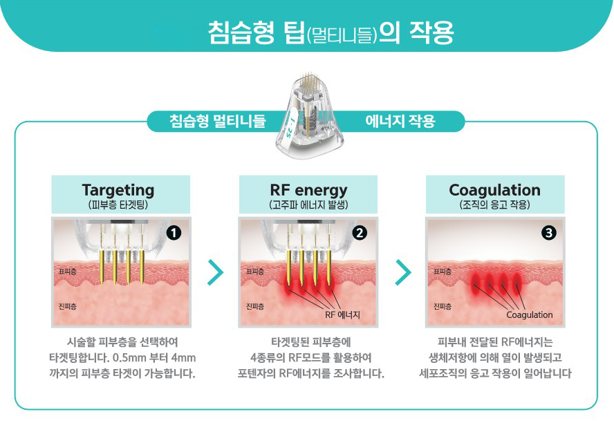 구로디지털단지역피부과 포텐자로 모공 흉터 탄력 리프팅까지! 관련 이미지 6