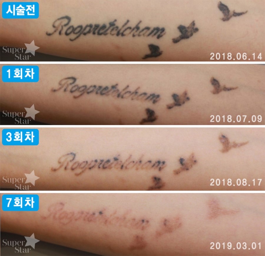 구로디지털단지역피부과 문신제거 정보드려요 관련 이미지 4