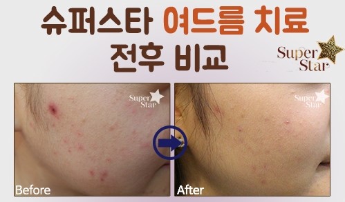 PDT 광역동치료!! 좁쌀여드름에 추천해요~ 관련 이미지 3