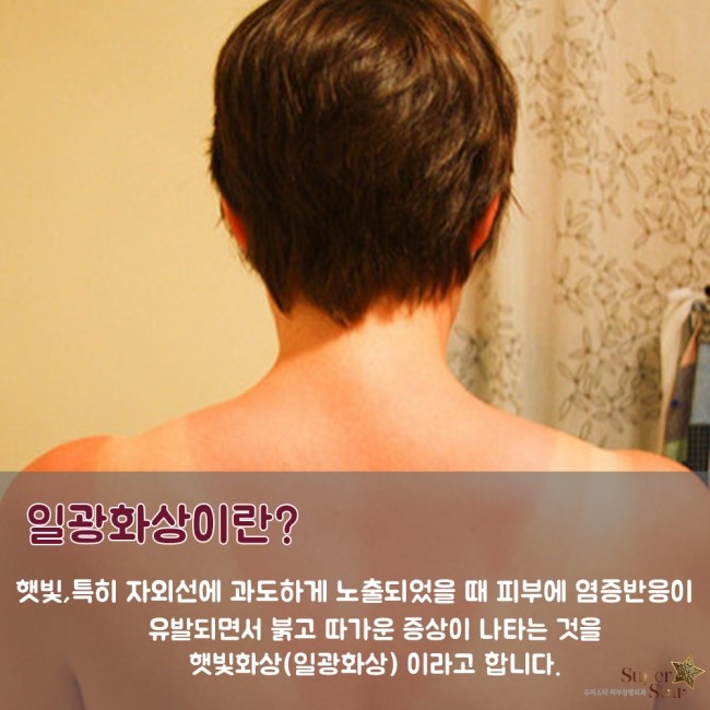 [구로피부과전문의] 슈퍼스타피부과가 알려주는 일광화상 처치방법~! 관련 이미지 2