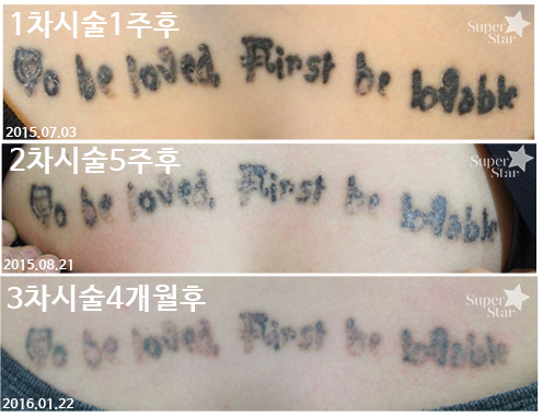 [구로피부과전문의]문신제거 확실한 효과가 있는 슈퍼스타피부과 피부과전문의에게 시술받으세요~ 관련 이미지 2