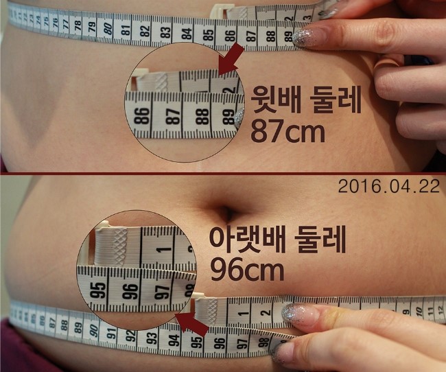 [구로피부과전문의] -비만패키지 첫번째 이야기 관련 이미지 5