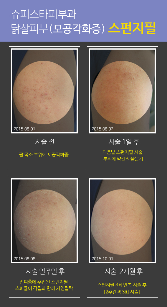 [구로디지털단지피부과]모공각화증 이겨내요~!!슈퍼스타피부과 스펀지필 대.공.개 관련 이미지 9