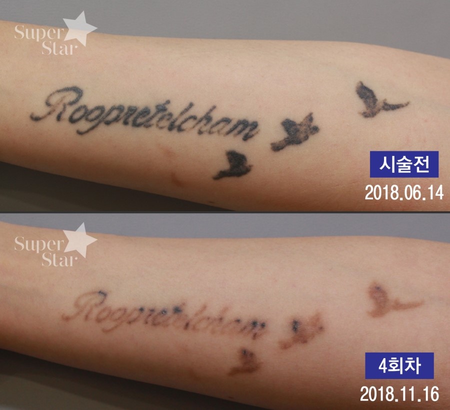 구로디지털단지역피부과 피코플러스로 문신/색소/여드름흉터를 빠르게치료하세요 관련 이미지 3
