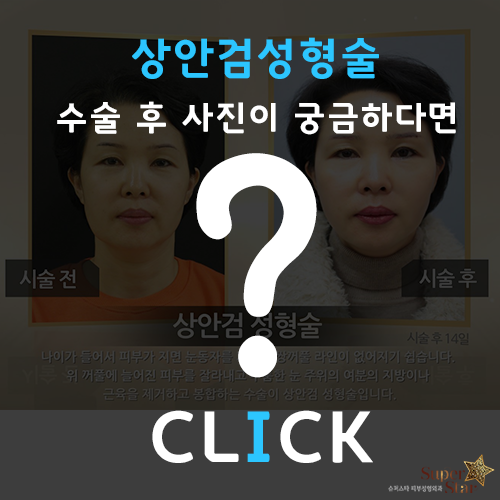 [구로눈성형]연말효도선물 상안검성형술~눈썹거상술을 통한 상안검교정~구로슈퍼스타피부과&성형외과 눈썹거상술 솔직한인터뷰! 관련 이미지 5