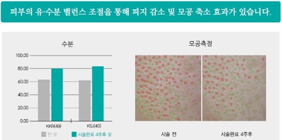 리쥬란 힐러로 젊고 건강한 피부를 회복하세요~ 관련 이미지 7