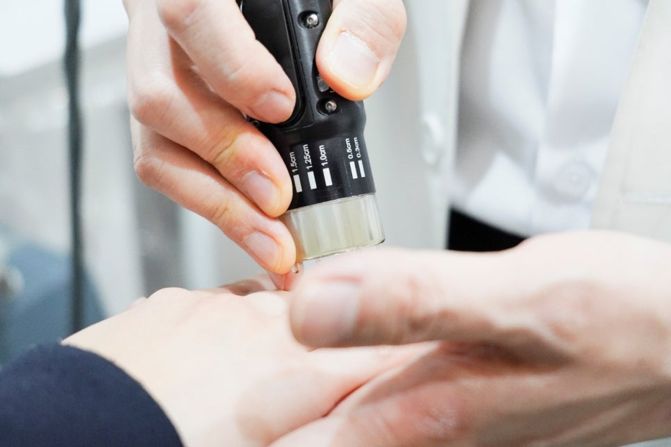 엑시머레이저피부과 백반증 치료, 상담 전 꼭 읽어 보세요! 관련 이미지 7