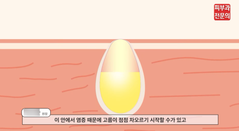 영등포시장역피부과 여드름 치료, 장기전으로 생각해야 합니다. 관련 이미지 5
