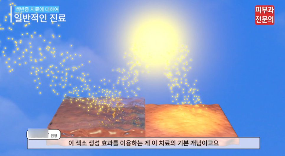 백반증엑시머 레이저 치료 전 꼭 알고 계셔야 할 핵심 정보 관련 이미지 5