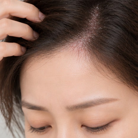 오목교역피부과 지루성피부염 치료, 증상이 좋아진 뒤에도 유지 관리가 필요한 이유는? 관련 이미지 3