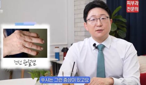 피부 건선치료법, 피부과 전문의가 정리해 드립니다. 관련 이미지 6