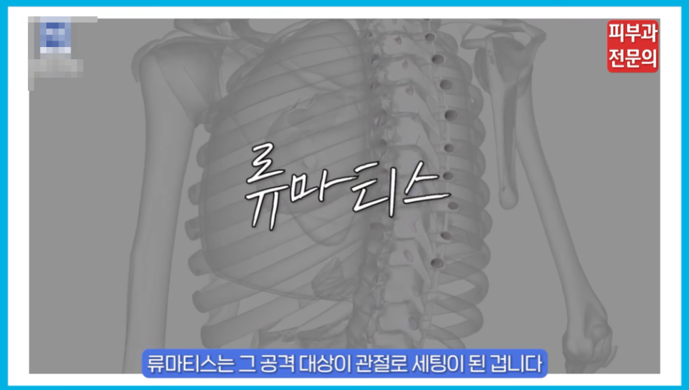 건선엑시머 치료에 있어서 가장 중요한 핵심 정보 관련 이미지 5
