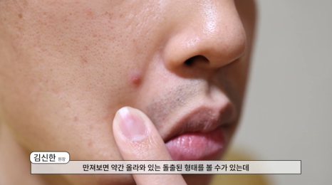 서울 화농성여드름피부과 추천, 치료 전 꼭 알아두셔야 할 것 관련 이미지 3