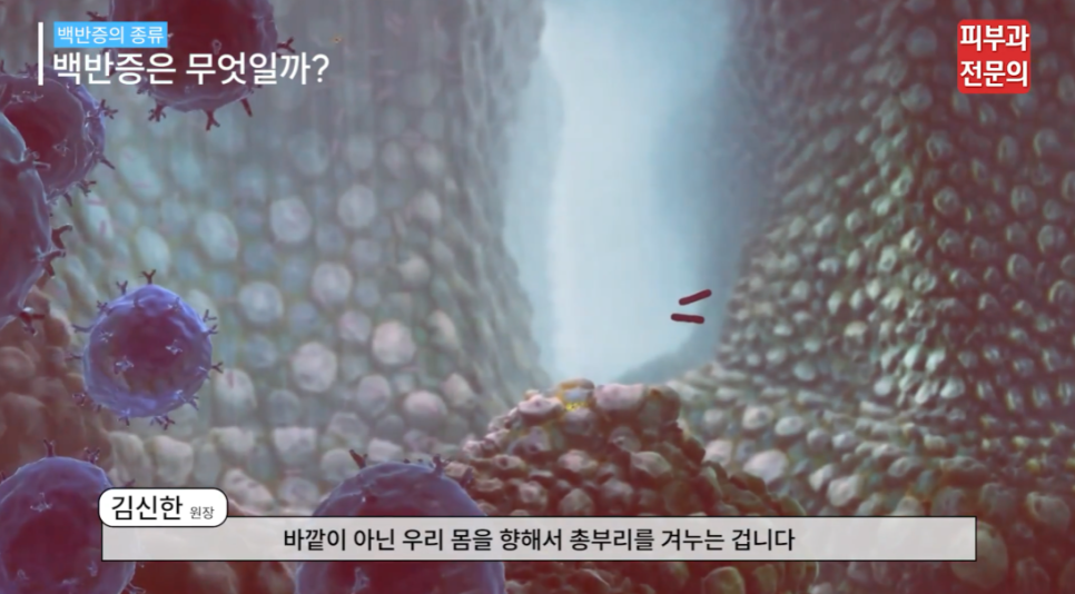 백반증치료피부과 전문의 진단 치료 시 가장 중요한 것은? 관련 이미지 5