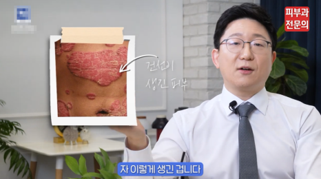 대림역 건선 광선치료 병원, 재발이 반복된다면 확인해야 할 부분 관련 이미지 7