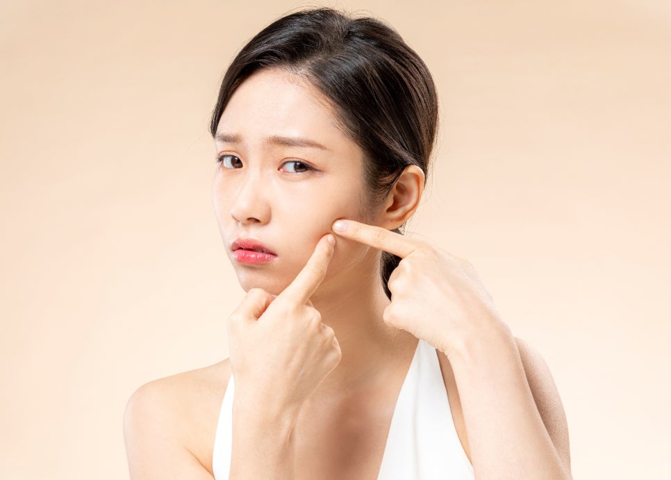 여드름붉은자국 레이저 치료 병원, 브이빔? 이렇게 진행됩니다. 관련 이미지 1