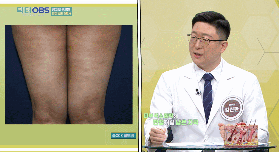 영등포피부과추천, 재발률 높은 건선, 방치하면 안 되는 이유 관련 이미지 3