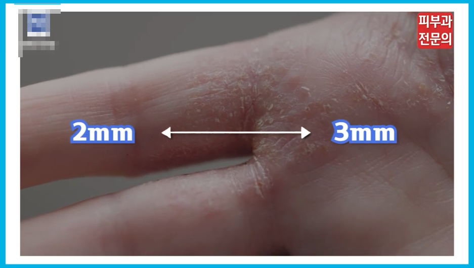 영등포 건선치료병원 재발 방지를 위해 기억해야 할 관리 수칙 관련 이미지 2