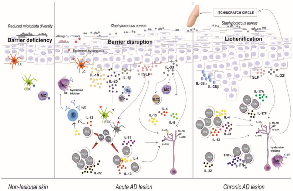 중증 아토피 치료 방법은? 관련 이미지 1