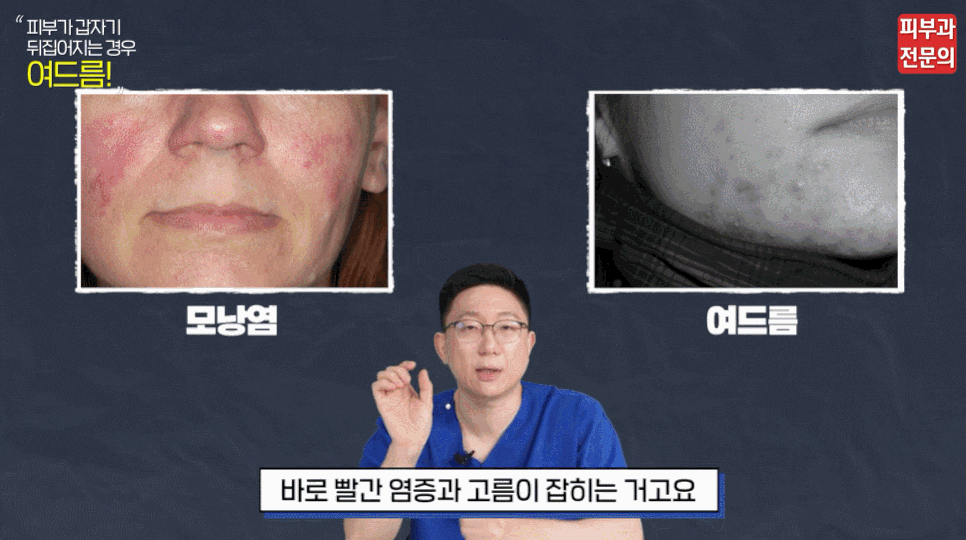 대림역피부과 추천? 여드름 모낭염 무작정 짜면 안 되는 이유 관련 이미지 3