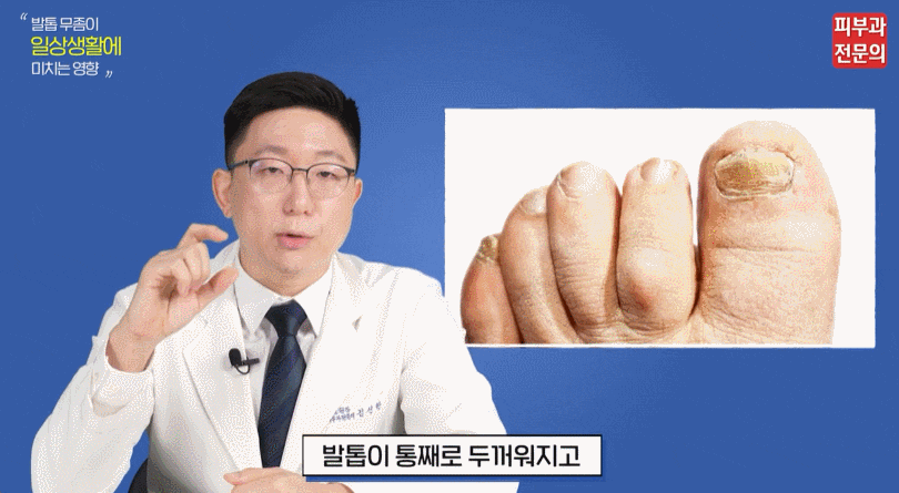 발톱무좀에 대하여 A부터 Z까지 짚어드립니다. 관련 이미지 3