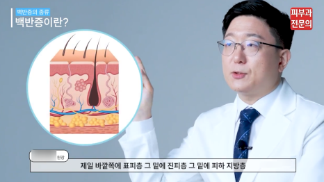신길역피부과 백반증 레이저 치료 전 꼭 알아 두어야 할 관련 이미지 4