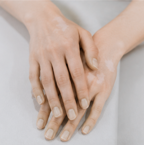 영등포역피부과 백반증 레이저 치료, 모든 백반증에 같은 치료가 필요할까요? 관련 이미지 3