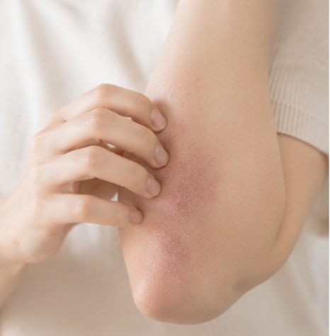 샛강역피부과 아토피 증상, 반복해서 긁는 부위가 두꺼워지고 거칠어진다면? 관련 이미지 3