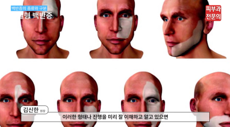 피부흰색반점 치료 백반증? 피부과 전문의가 말하는 핵심 관련 이미지 4