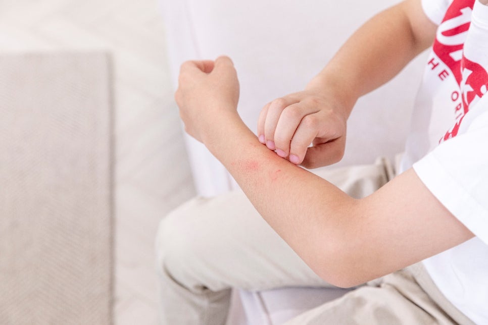 피부아토피치료 병원, 광선치료? 이것 꼭 주의하셔야 합니다. 관련 이미지 1