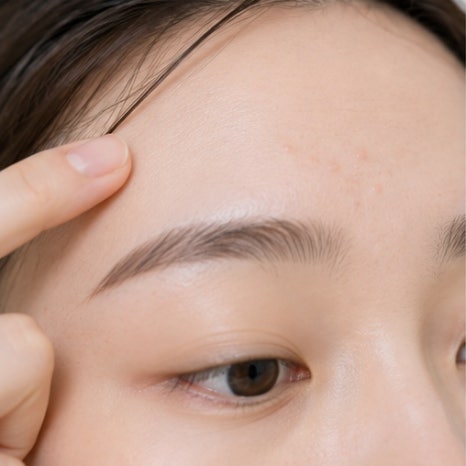 오목교역피부과 여드름 압출치료, 좁쌀여드름이 염증성으로 변하기 전에 관리해야 할까요? 관련 이미지 2