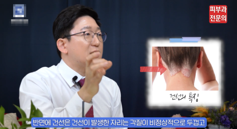 대림역피부과 전문의, 건선 치료 관리 주의사항은? 관련 이미지 6