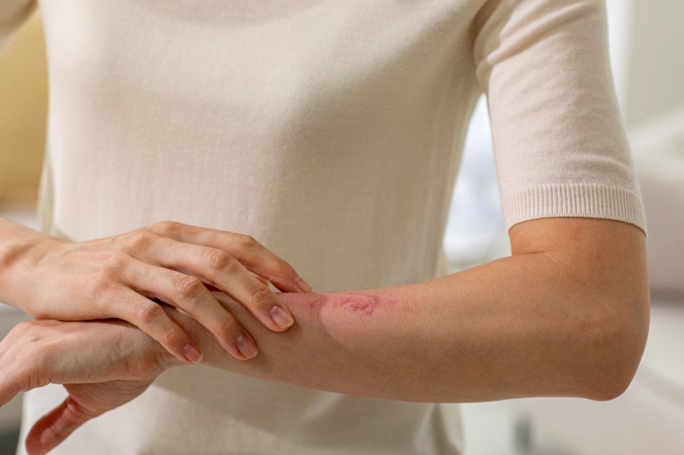 서울아토피피부과 추천 스테로이드연고, 이렇게 사용해야 합니다. 관련 이미지 1