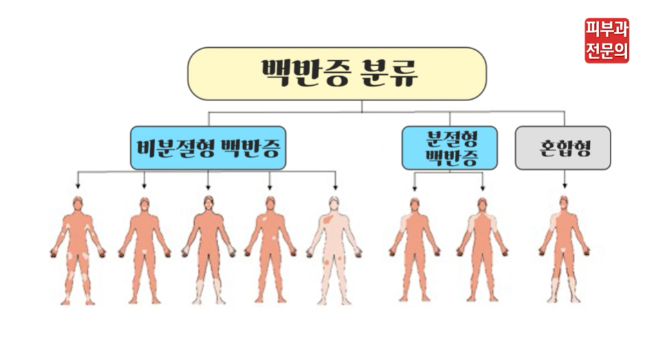 영등포타임스퀘어피부과 흰색 반점의 원인 백반증, 빠른 치료가 필요한 이유 관련 이미지 4