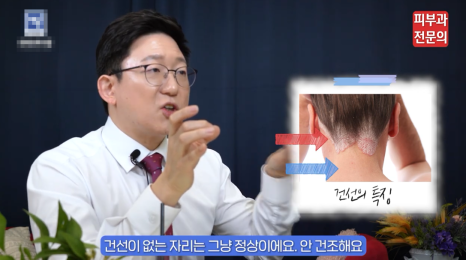 건선레이저치료 방법, 피부과 방문 전 꼭 읽어 보세요. 관련 이미지 5