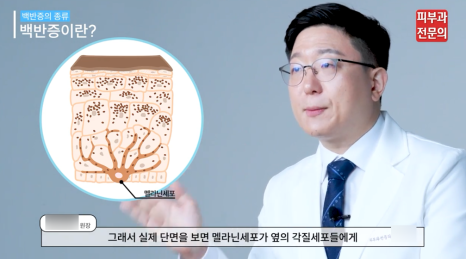 백반증치료방법 엑시머 레이저 장점과 기대 효과는? <총정리> 관련 이미지 3