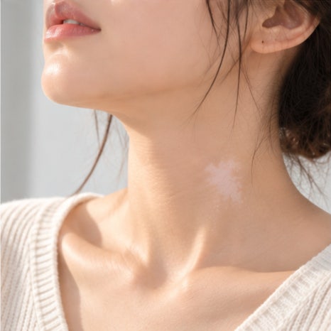 보라매역피부과 백반증, 흰 반점이 더 커지지 않아도 치료를 계속해야 할까요? 관련 이미지 4